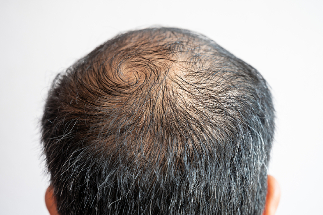 Why Is My Hair Thinning at 30? Causes & Treatments