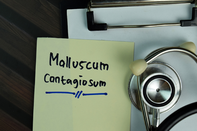 Is It Just a Pimple? A Doctor's Guide to Molluscum Contagiosum